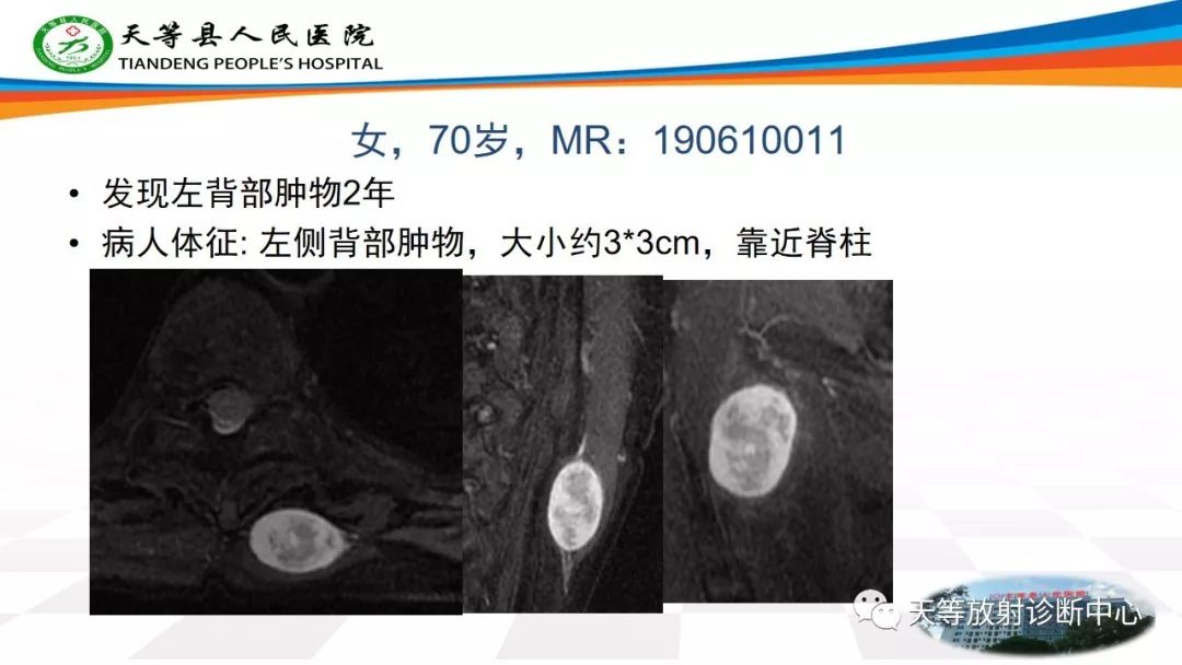影像PPT - 【PPT】软组织神经鞘瘤影像学诊断-9