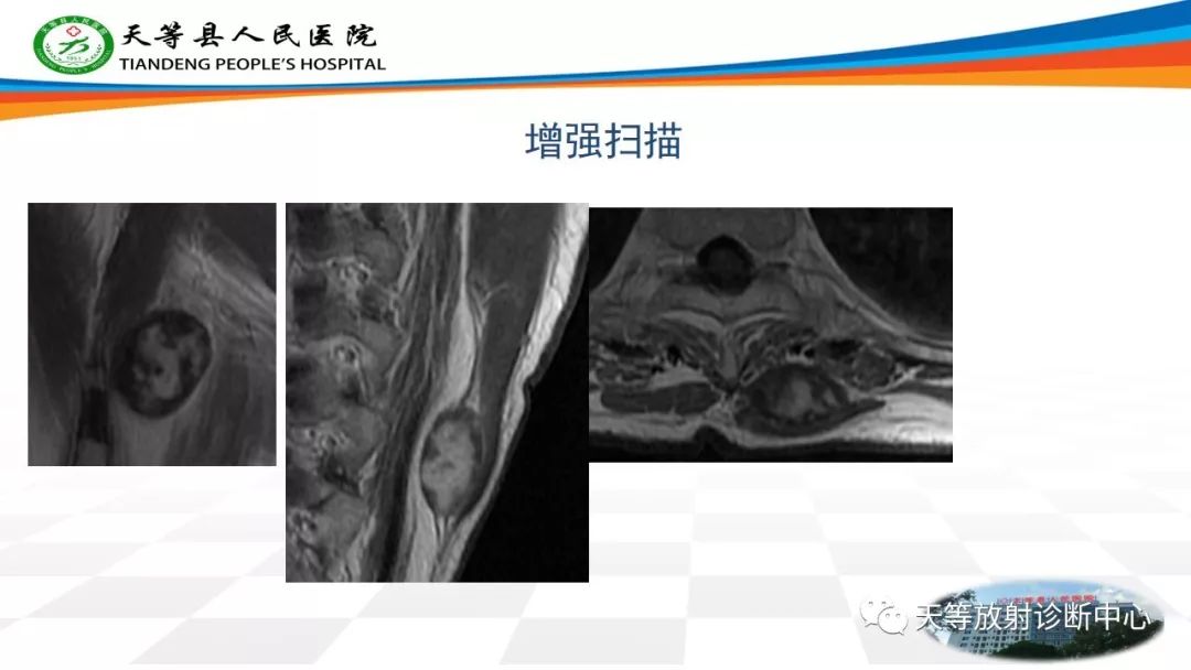 影像PPT - 【PPT】软组织神经鞘瘤影像学诊断-10