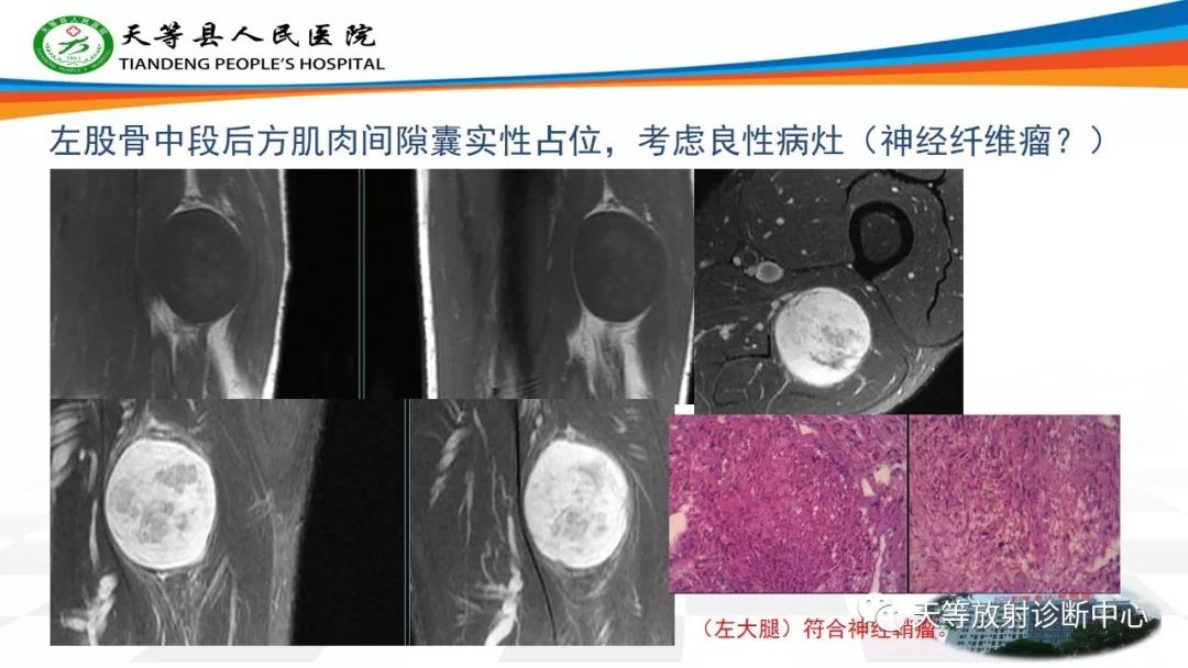 影像PPT - 【PPT】软组织神经鞘瘤影像学诊断-12