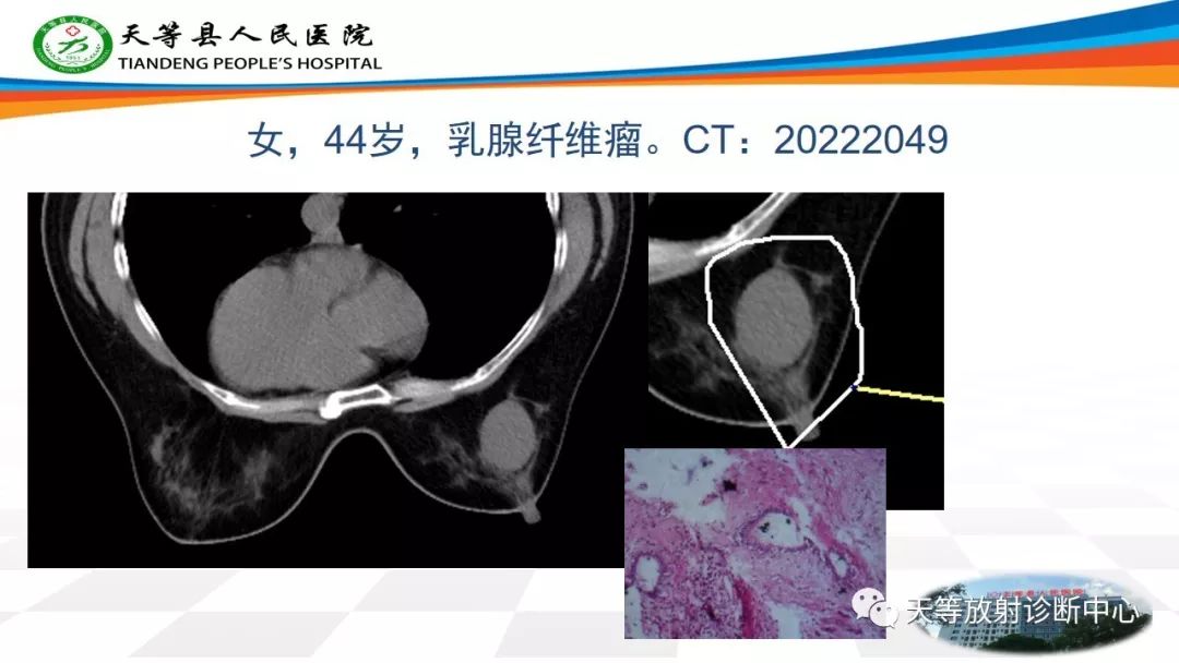 影像PPT - 【PPT】软组织神经鞘瘤影像学诊断-18