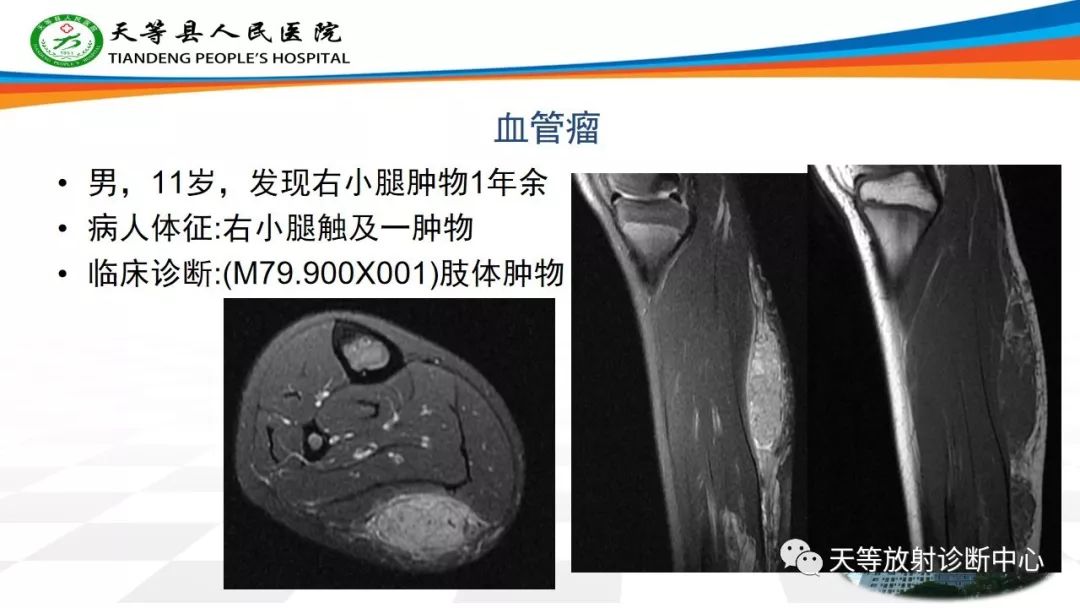 影像PPT - 【PPT】软组织神经鞘瘤影像学诊断-20