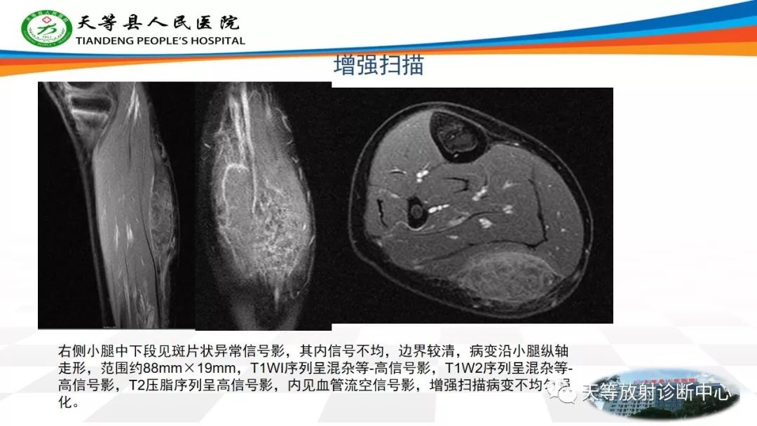 影像PPT - 【PPT】软组织神经鞘瘤影像学诊断-21