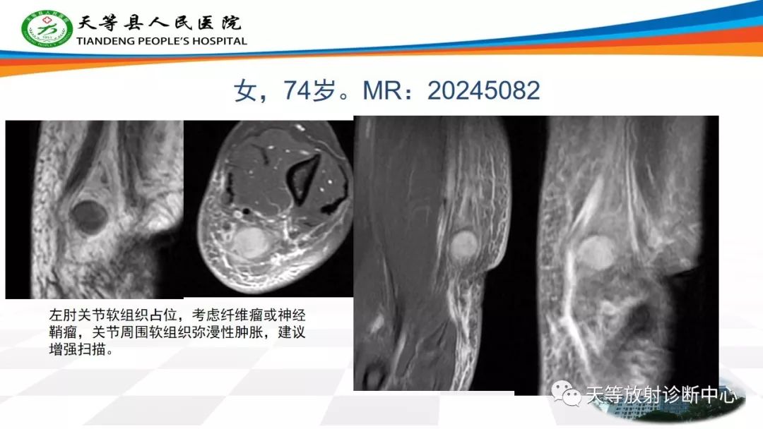 影像PPT - 【PPT】软组织神经鞘瘤影像学诊断-22
