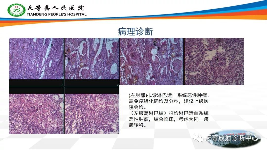 影像PPT - 【PPT】软组织神经鞘瘤影像学诊断-23