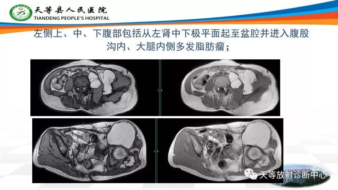 影像PPT - 【PPT】软组织神经鞘瘤影像学诊断-25