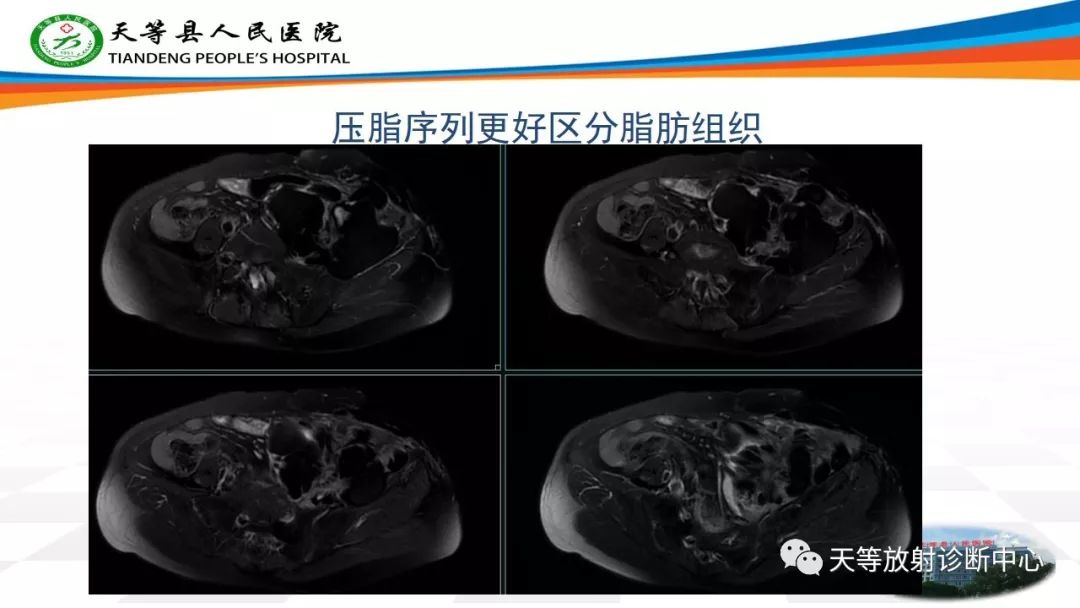 影像PPT - 【PPT】软组织神经鞘瘤影像学诊断-26