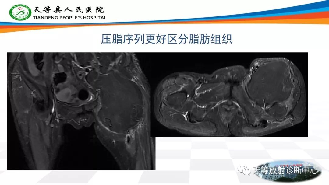 影像PPT - 【PPT】软组织神经鞘瘤影像学诊断-27