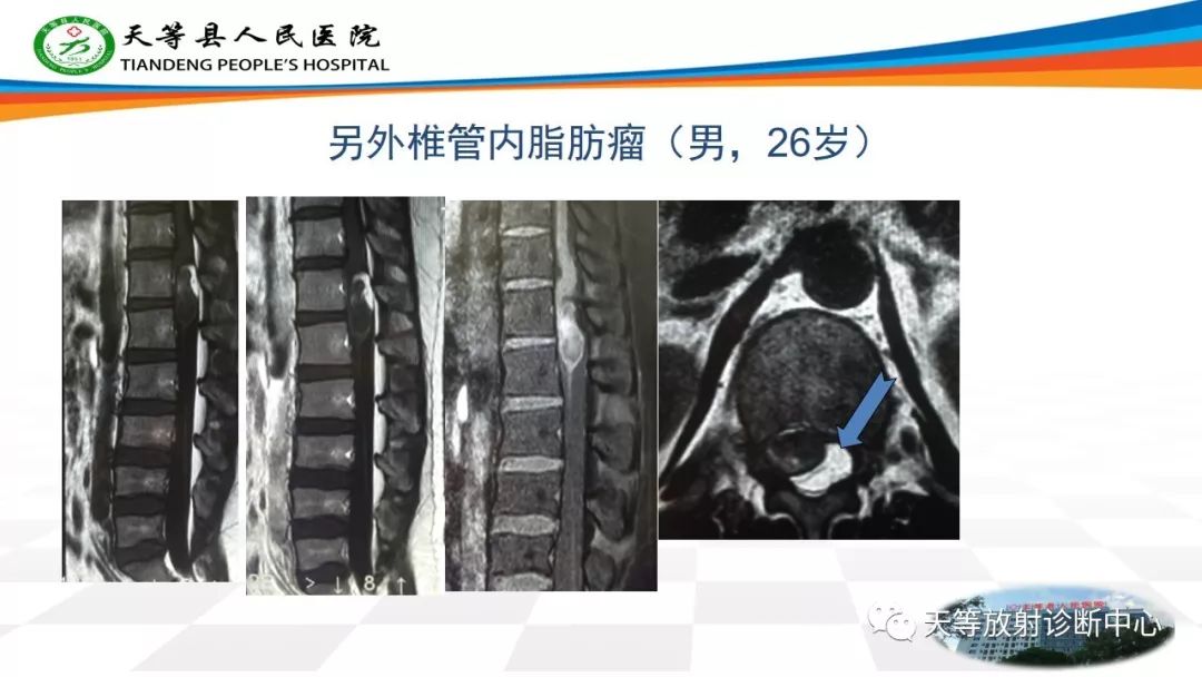 影像PPT - 【PPT】软组织神经鞘瘤影像学诊断-28