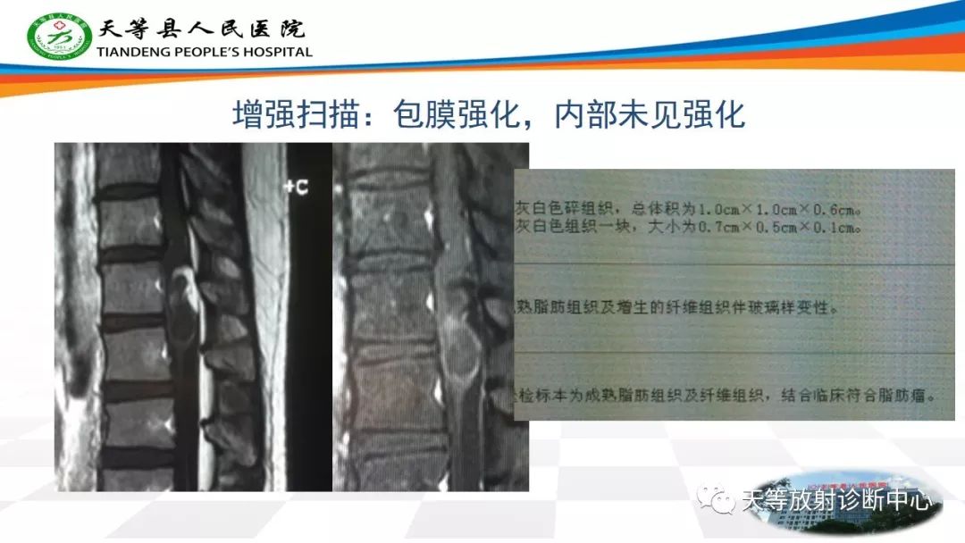 影像PPT - 【PPT】软组织神经鞘瘤影像学诊断-29