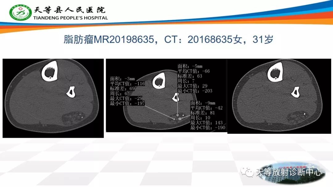 影像PPT - 【PPT】软组织神经鞘瘤影像学诊断-30