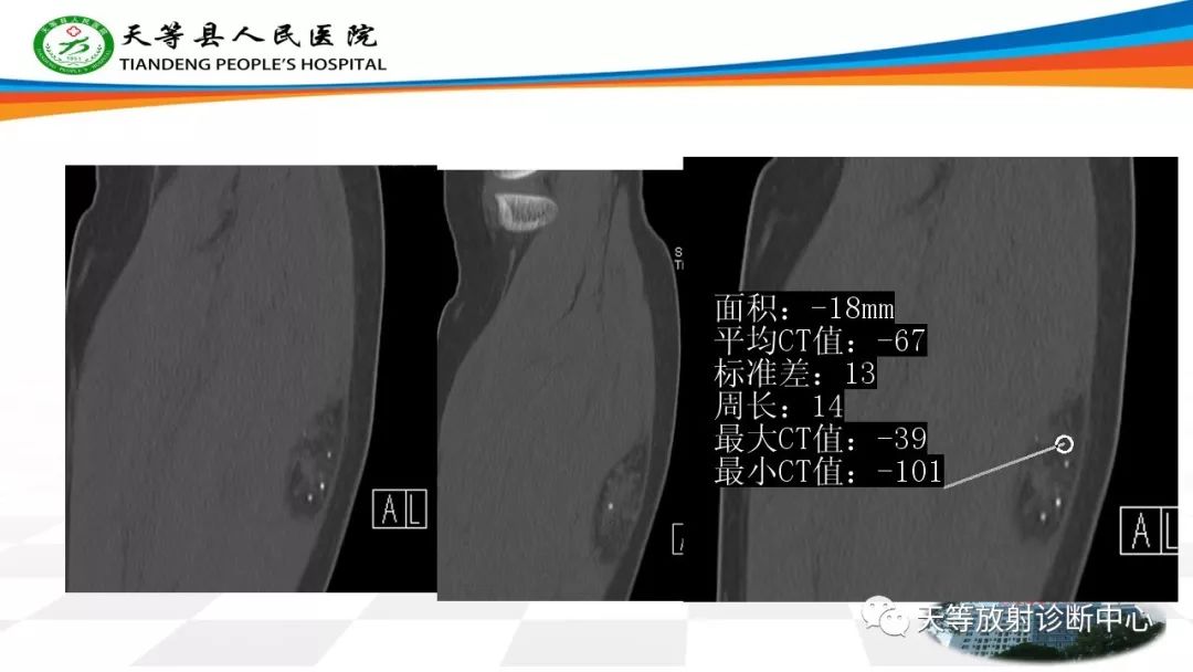 影像PPT - 【PPT】软组织神经鞘瘤影像学诊断-31