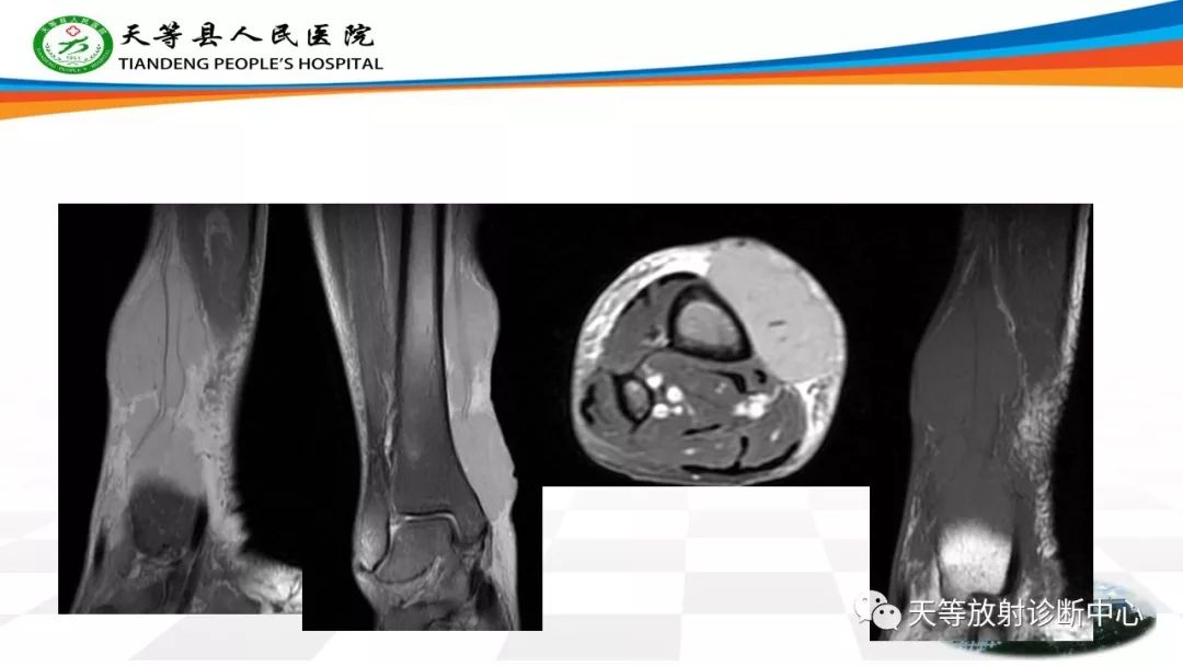 影像PPT - 【PPT】软组织神经鞘瘤影像学诊断-33