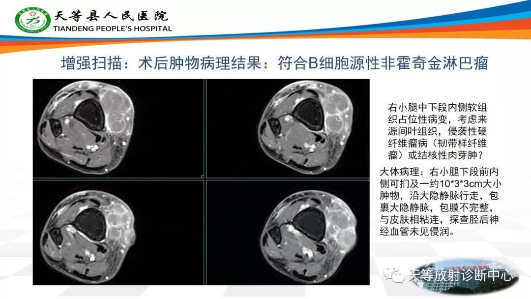 影像PPT - 【PPT】软组织神经鞘瘤影像学诊断-34