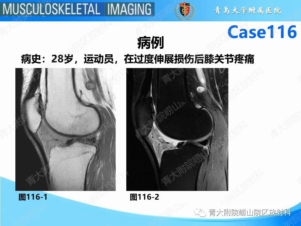 影像PPT - 【PPT】Hoffa病-2