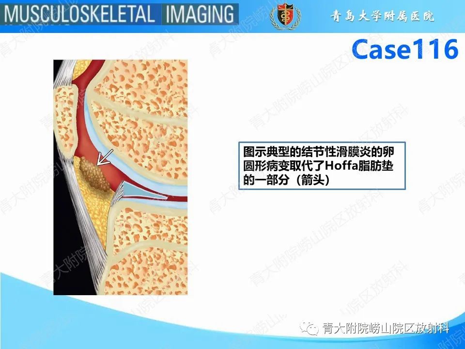 影像PPT - 【PPT】Hoffa病-6
