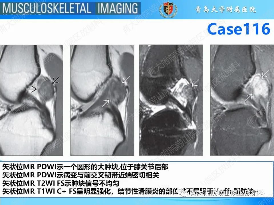 影像PPT - 【PPT】Hoffa病-7