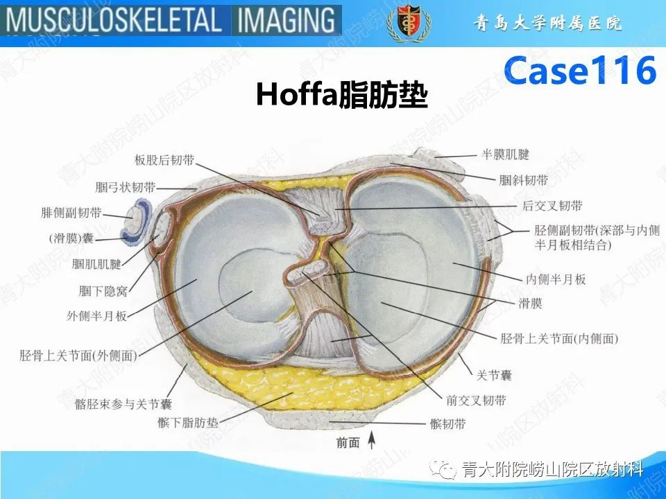 影像PPT - 【PPT】Hoffa病-10