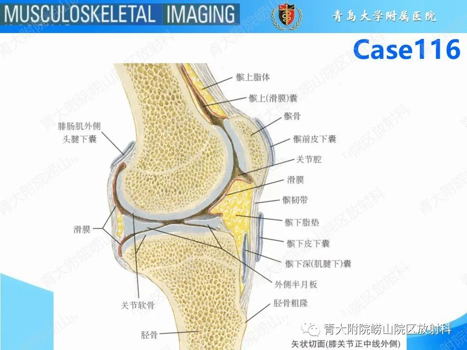 影像PPT - 【PPT】Hoffa病-11