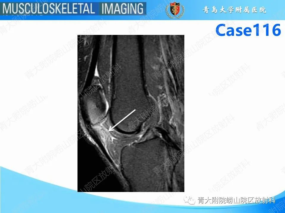 影像PPT - 【PPT】Hoffa病-15