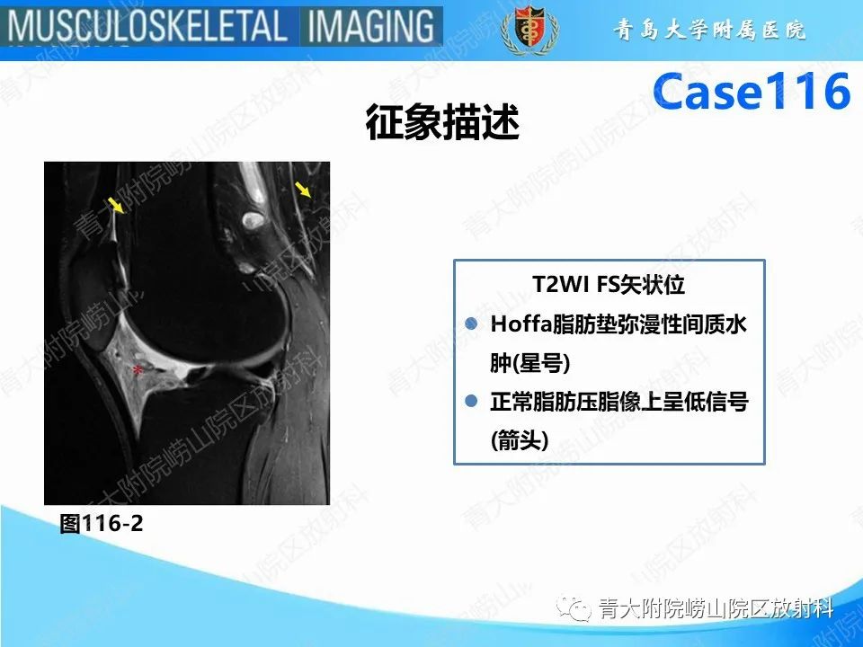 影像PPT - 【PPT】Hoffa病-23