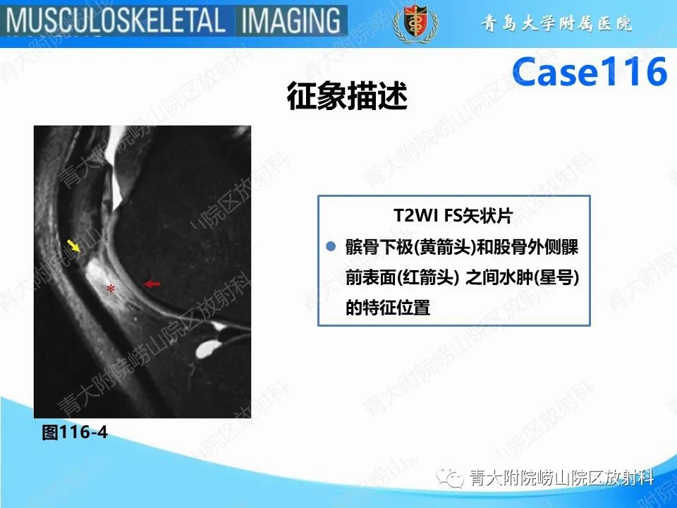 影像PPT - 【PPT】Hoffa病-25