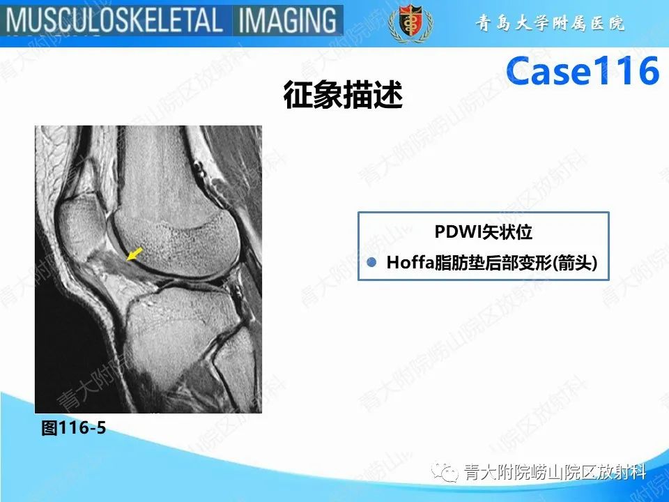 影像PPT - 【PPT】Hoffa病-26