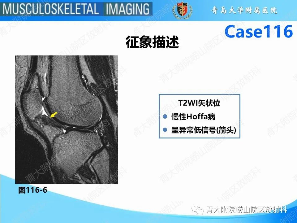 影像PPT - 【PPT】Hoffa病-27