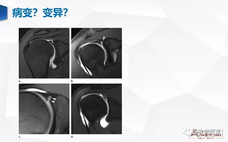 影像PPT - 【PPT】肩关节盂唇解剖及变异-3