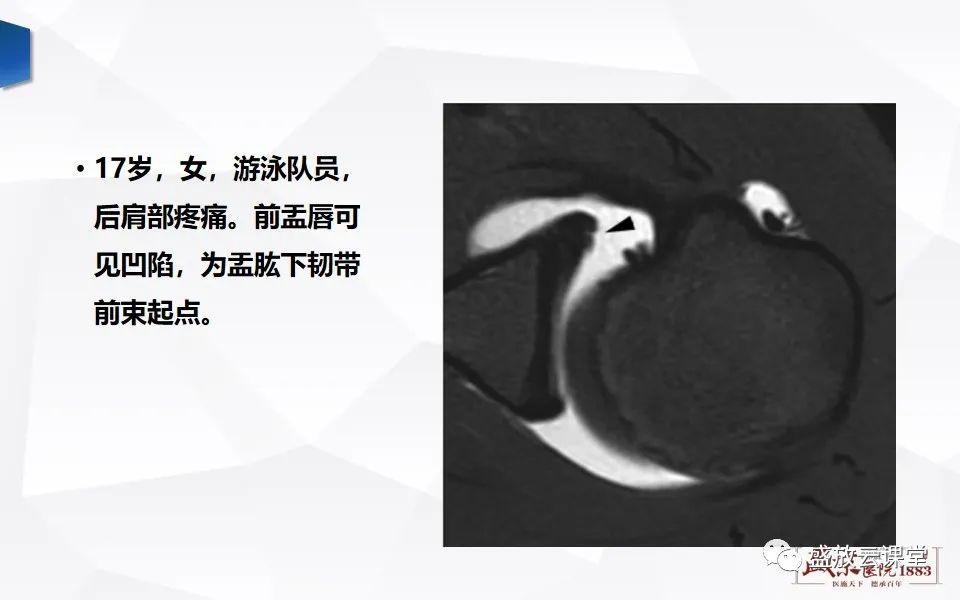 影像PPT - 【PPT】肩关节盂唇解剖及变异-7
