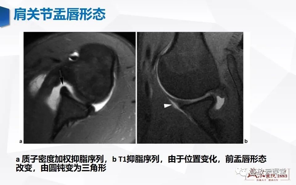 影像PPT - 【PPT】肩关节盂唇解剖及变异-9