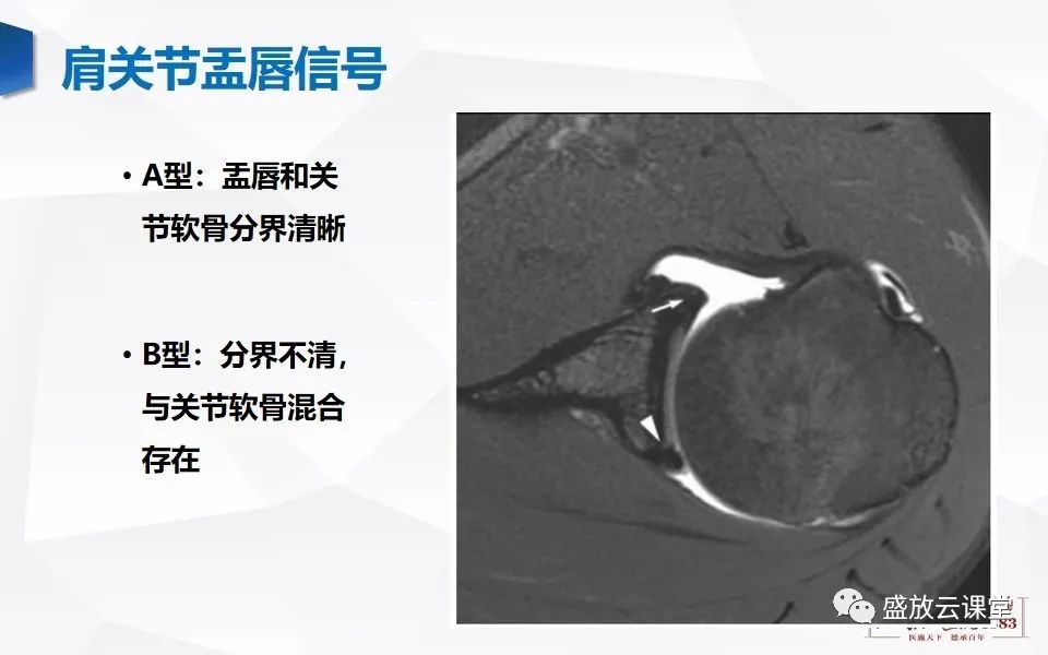 影像PPT - 【PPT】肩关节盂唇解剖及变异-10