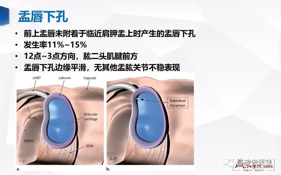影像PPT - 【PPT】肩关节盂唇解剖及变异-14