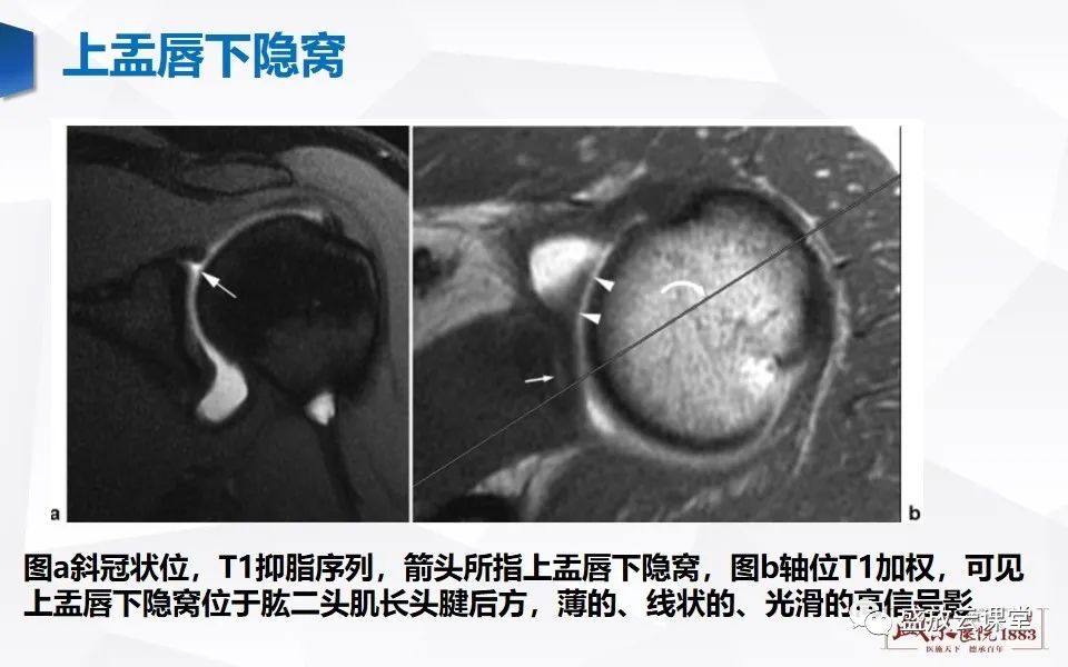 影像PPT - 【PPT】肩关节盂唇解剖及变异-13