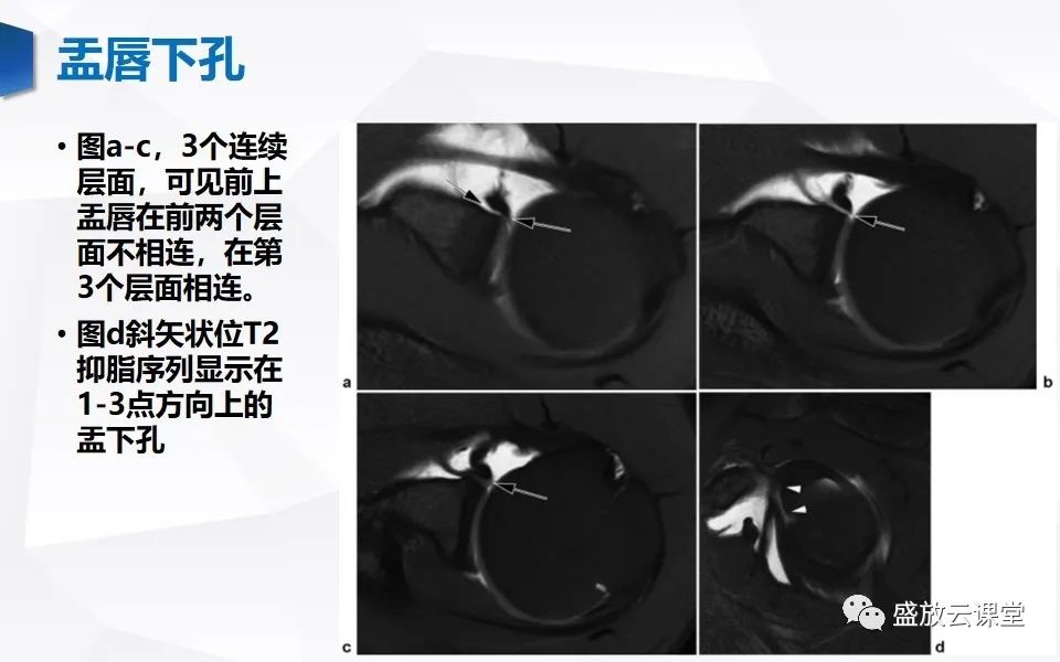 影像PPT - 【PPT】肩关节盂唇解剖及变异-16