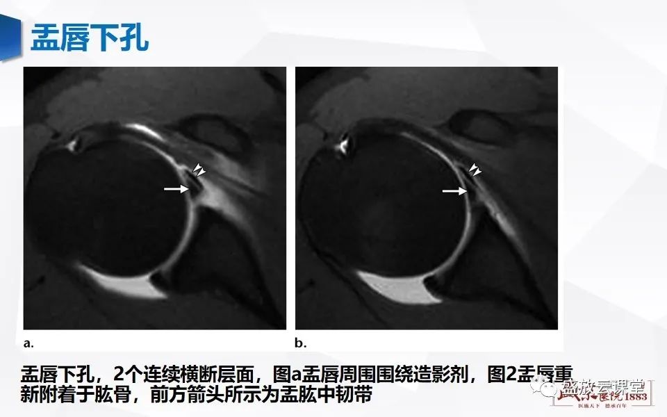 影像PPT - 【PPT】肩关节盂唇解剖及变异-17