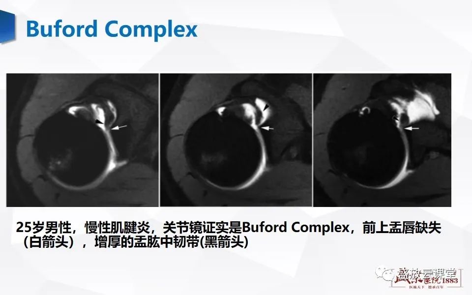 影像PPT - 【PPT】肩关节盂唇解剖及变异-19