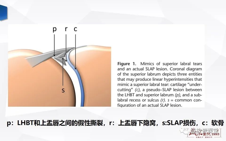 影像PPT - 【PPT】肩关节盂唇解剖及变异-20