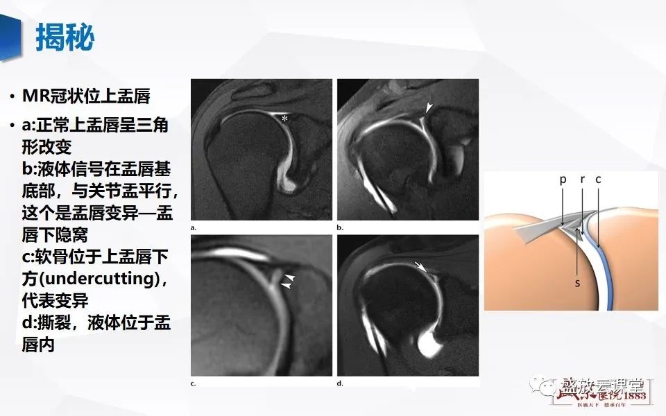 影像PPT - 【PPT】肩关节盂唇解剖及变异-21