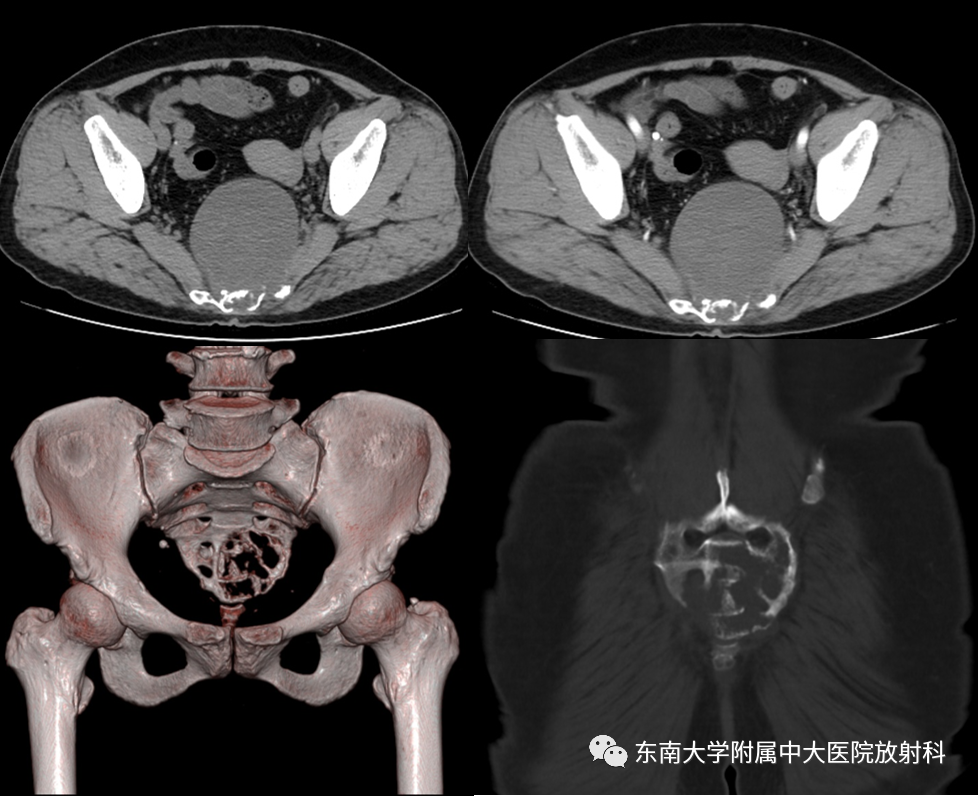影像PPT - 【PPT】骶骨常见肿瘤-1 影像PPT - 【PPT】骶骨常见肿瘤-1