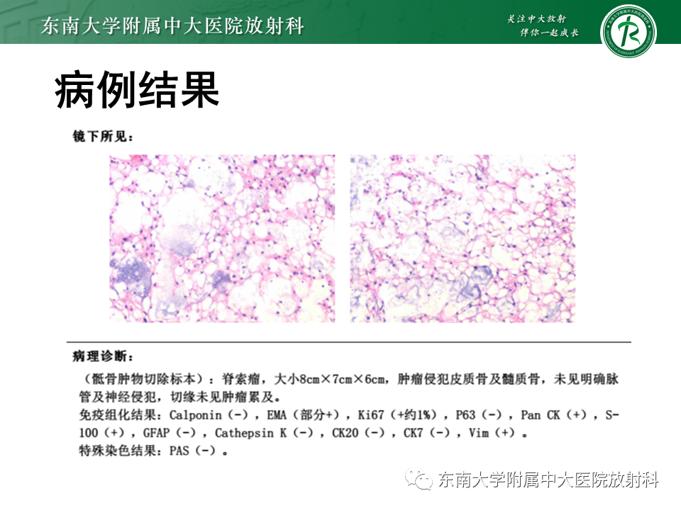 影像PPT - 【PPT】骶骨常见肿瘤-3 影像PPT - 【PPT】骶骨常见肿瘤-3