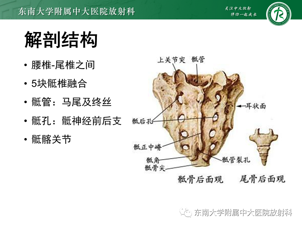 影像PPT - 【PPT】骶骨常见肿瘤-5 影像PPT - 【PPT】骶骨常见肿瘤-5