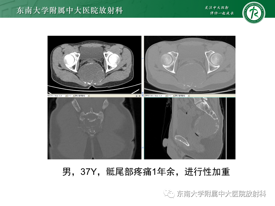影像PPT - 【PPT】骶骨常见肿瘤-14 影像PPT - 【PPT】骶骨常见肿瘤-14