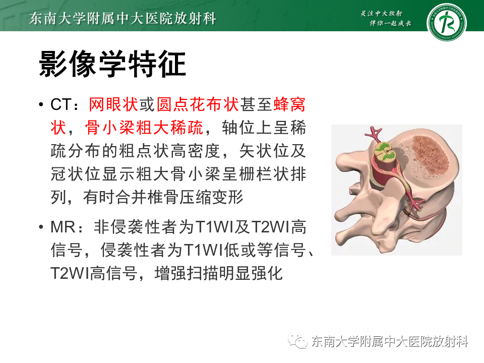 影像PPT - 【PPT】骶骨常见肿瘤-16 影像PPT - 【PPT】骶骨常见肿瘤-16