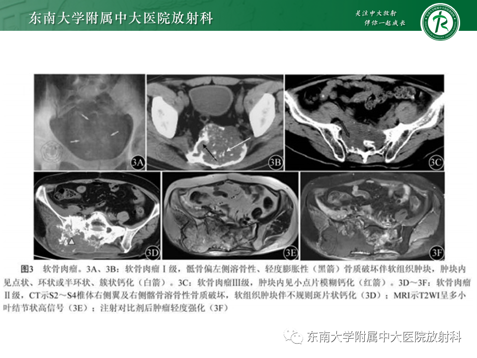 影像PPT - 【PPT】骶骨常见肿瘤-20 影像PPT - 【PPT】骶骨常见肿瘤-20