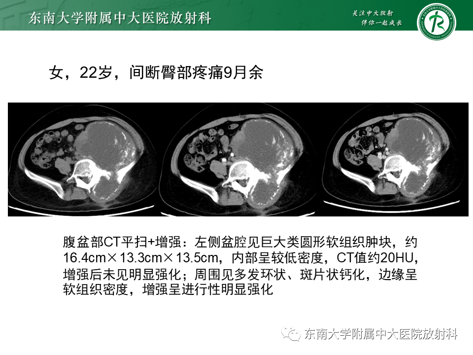 影像PPT - 【PPT】骶骨常见肿瘤-21 影像PPT - 【PPT】骶骨常见肿瘤-21