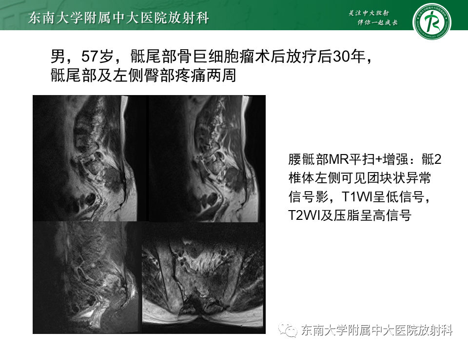 影像PPT - 【PPT】骶骨常见肿瘤-25 影像PPT - 【PPT】骶骨常见肿瘤-25