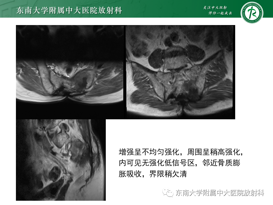 影像PPT - 【PPT】骶骨常见肿瘤-26 影像PPT - 【PPT】骶骨常见肿瘤-26