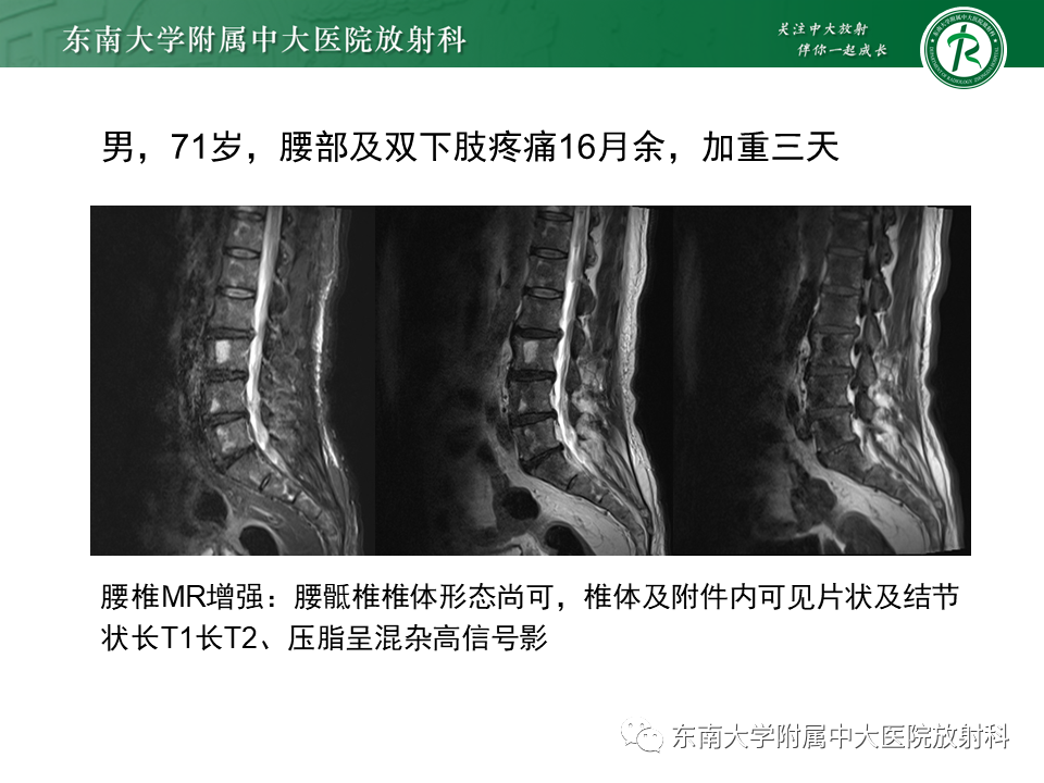 影像PPT - 【PPT】骶骨常见肿瘤-29 影像PPT - 【PPT】骶骨常见肿瘤-29