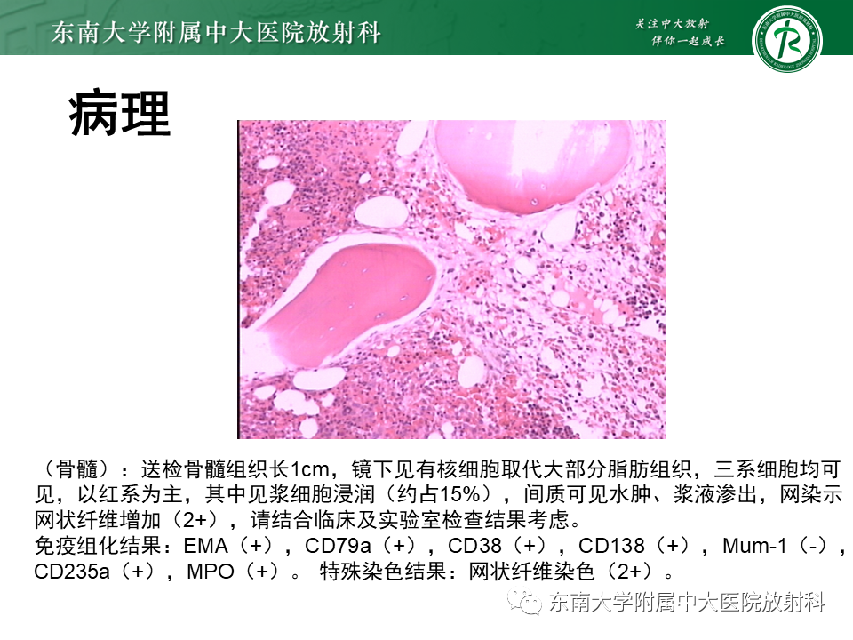 影像PPT - 【PPT】骶骨常见肿瘤-30 影像PPT - 【PPT】骶骨常见肿瘤-30