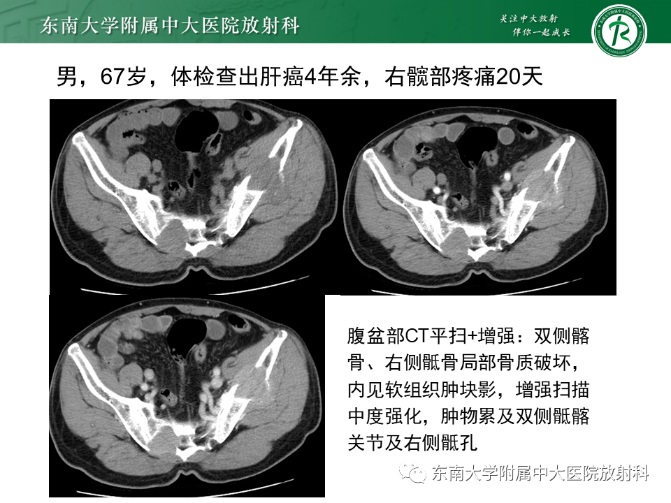 影像PPT - 【PPT】骶骨常见肿瘤-32 影像PPT - 【PPT】骶骨常见肿瘤-32